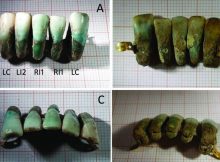 The dentures found in the tomb are the first example of dentures from this historical period, and as such are a valuable addition to the history of dentistry. Image Credits: Photo: University of Pisa via The Local