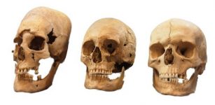 These are strong, intermediate, and non-deformed skulls (from left to right) from the Early Medieval sites Altenerding and Straubing in Bavaria, Germany. Credit: State Collection for Anthropology and Palaeoanatomy Munich