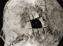 Trepanned skull from ancient Peru. The operation has been performed by means of a series of incisions placed at right angles to each other. Credits: cambridge.org