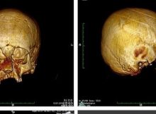 CT scans of the so called circular-erect type cranial deformation. CREDIT M Kavka