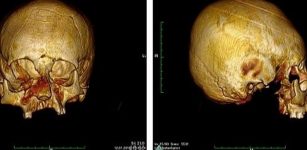 CT scans of the so called circular-erect type cranial deformation. CREDIT M Kavka