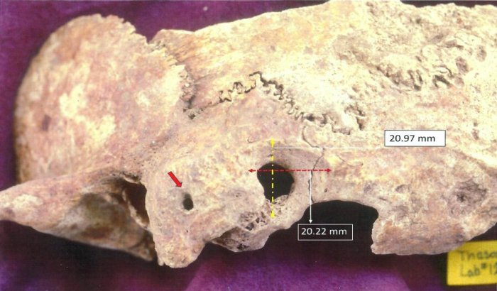 Ectocranial view of palaeopathological specimen: a) red arrow points to orifice on the mastoid process,and b) surgical preparation dimensions peripheral to trephination. Credit: Anagnostis P. Agelarakis/Adelphi University