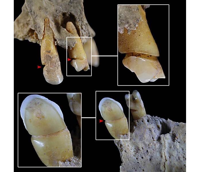 Individual 90 from Castellón Alto, showing evidence of the use of teeth for non-masticatory purposes. Credit: Ángel Rubio Salvador