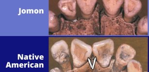 Jomon teeth vs Native American teeth. Credit: G. Richard Scott, University of Nevada Reno