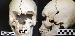 Ancient Caribbean Skull Shows Evidence Of Leprosy