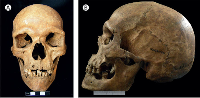 Oldest Case Of A Rare Genetic Condition Discovered